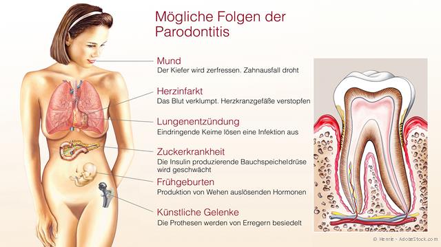Gesundheitsrisiko Parodontitis
