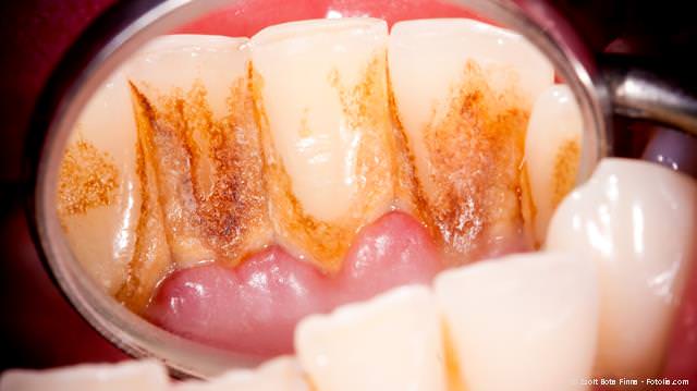 Mangelhafte Mundhygiene und Zahnbelag