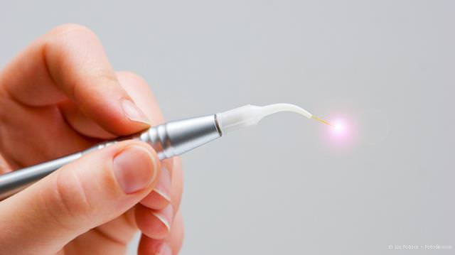Laser-Behandlung
